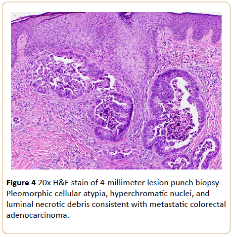 Archives-Cancer-Research-Pleomorphic-cellular