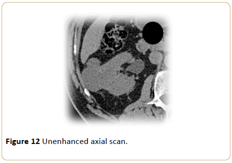 Archives-Cancer-Research-Unenhanced-axial-scan