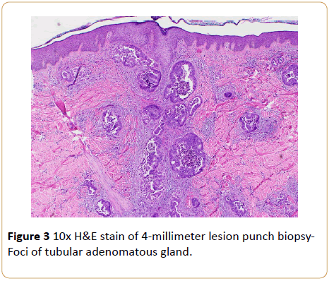 Archives-Cancer-Research-biopsy-Foci