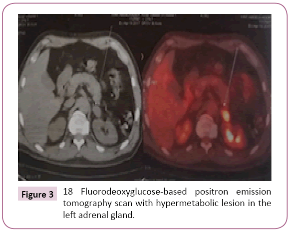 Archives-Cancer-Research-hypermetabolic-lesion