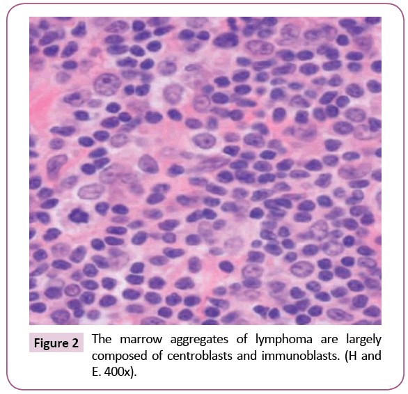 Archives-Cancer-Research-marrow-aggregates