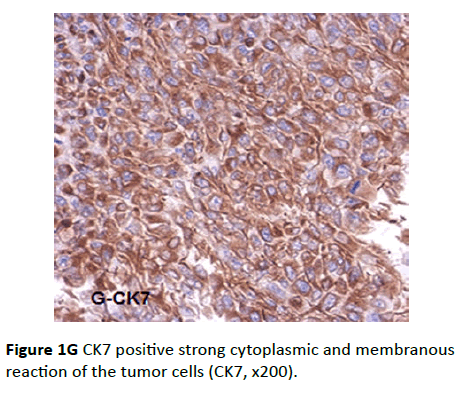 Archives-Cancer-Research-membranous-reaction