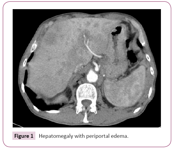 Archives-Cancer-Research-periportal-edema