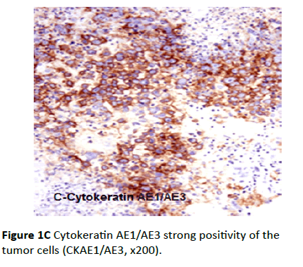 Archives-Cancer-Research-positivity-tumor-cells