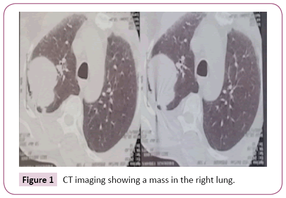 Archives-Cancer-Research-right-lung