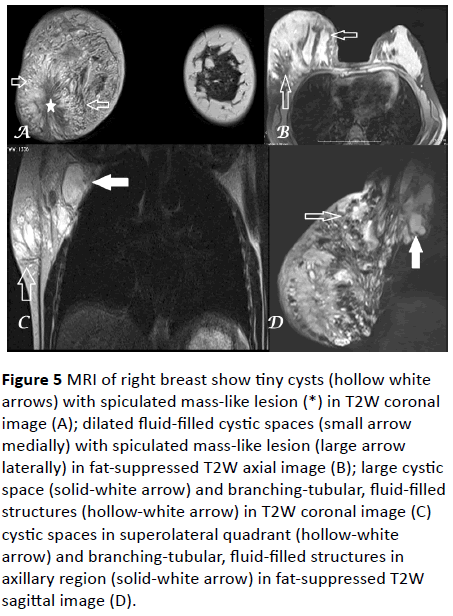 Archives-Cancer-Research-spiculated-mass-like