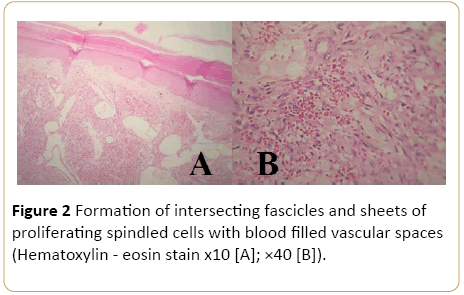 Archives-Cancer-Research-spindled-cells