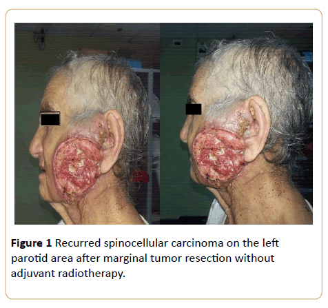 Archives-Cancer-Research-spinocellular-carcinoma