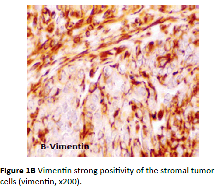 Archives-Cancer-Research-stromal-tumor-cells