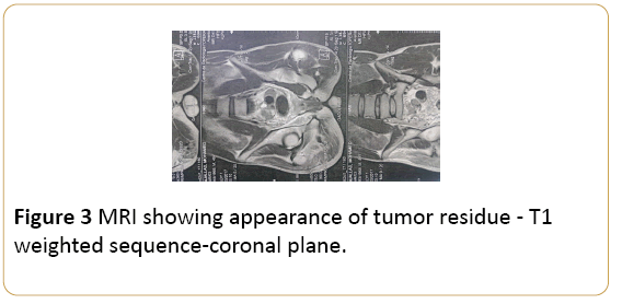 Archives-Cancer-Research-tumor-residue