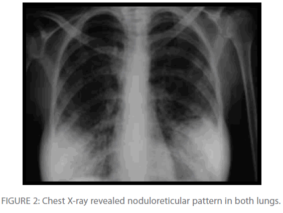 Archives-Clinical-Microbiology-Chest-X-ray-revealed