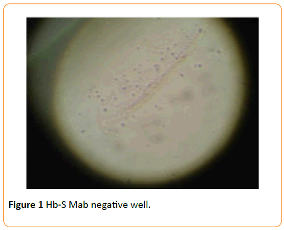 Archives-Clinical-Microbiology-Hb-S-Mab-negative-well