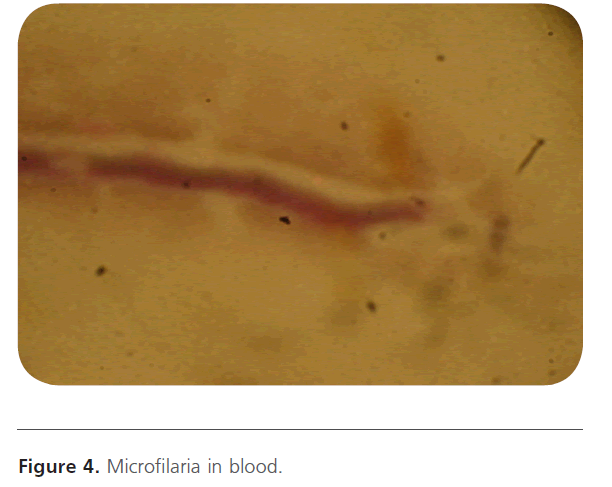 Archives-Clinical-Microbiology-Microfilaria-blood
