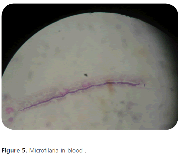 Archives-Clinical-Microbiology-Microfilaria-blood