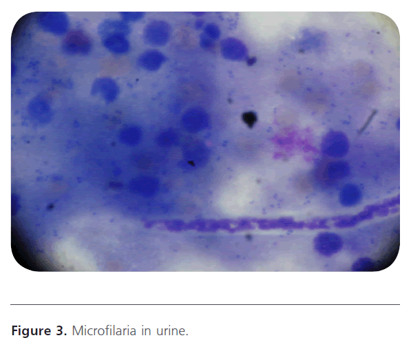 Archives-Clinical-Microbiology-Microfilaria-urine