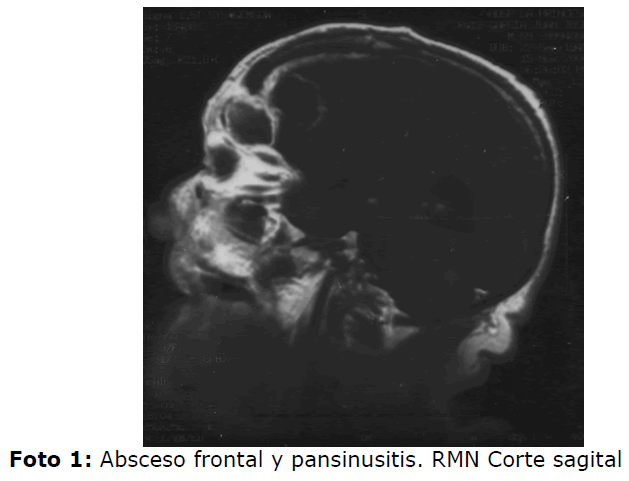 Archivos-de-Medicina-Absceso-frontal