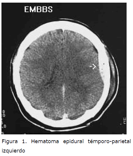 Archivos-de-Medicina-Hematoma-epidural