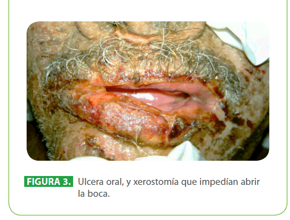 Archivos-de-Medicina-Ulcera-oral