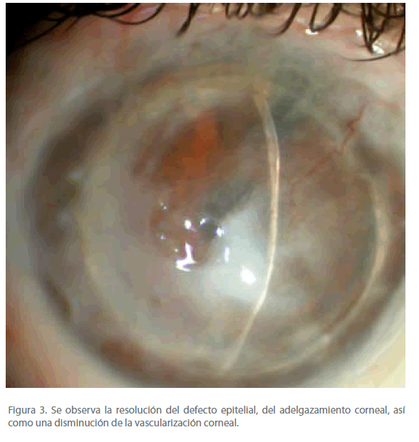 Archivos-de-Medicina-adelgazamiento-corneal