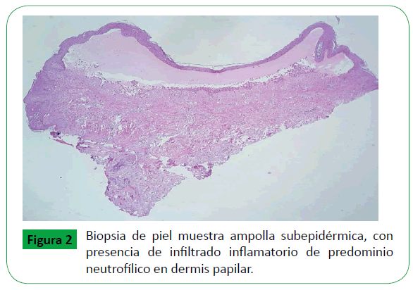 Archivos-de-Medicina-infiltrado-inflamatorio