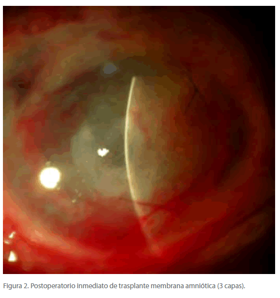 Archivos-de-Medicina-trasplante-membrana