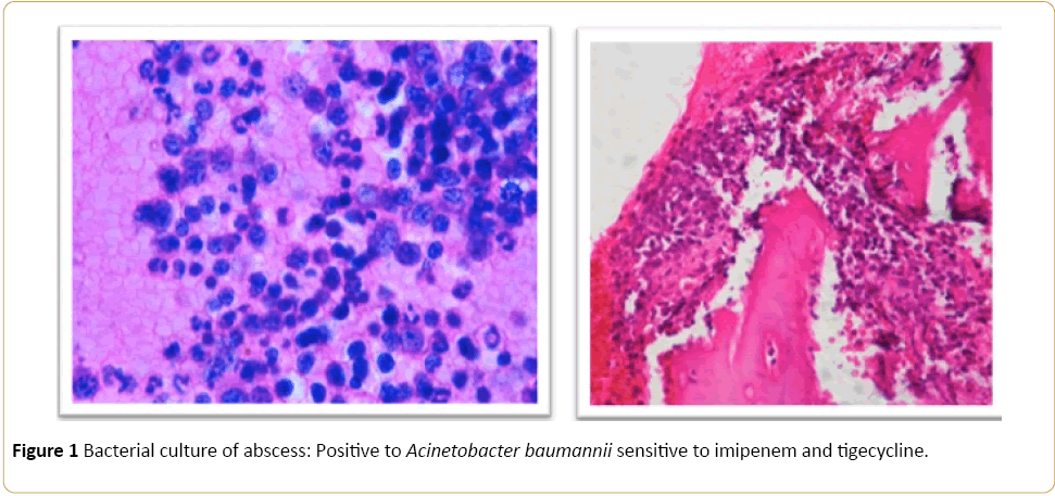 Cancer-Research-Bacterial-culture-abscess