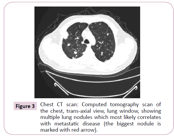 Cancer-Research-Computed-tomography