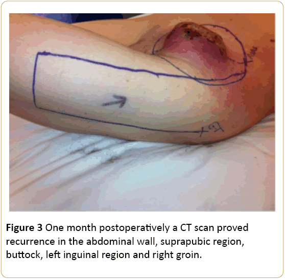 Cancer-Research-One-month-postoperatively