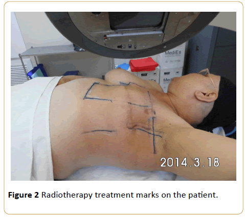 Cancer-Research-Radiotherapy-treatment-marks-patient