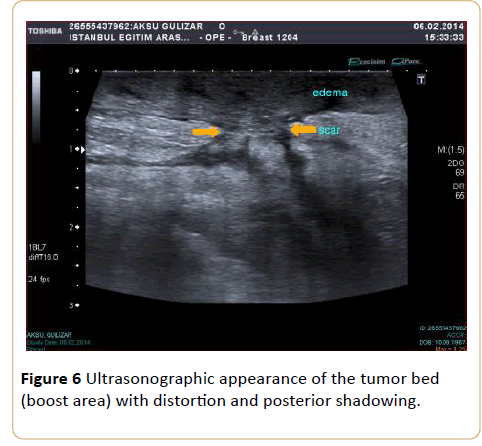 Cancer-Research-Ultrasonographic-appearance-tumor