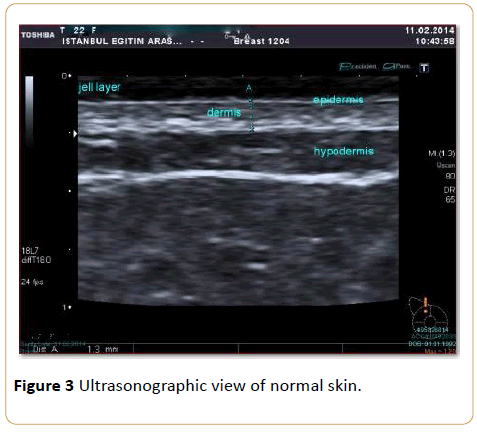 Cancer-Research-Ultrasonographic-view-normal-skin