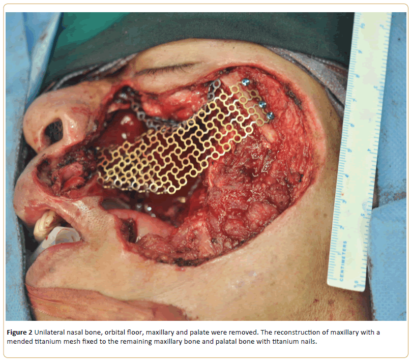 Cancer-Research-Unilateral-nasal-bone