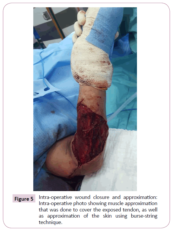 Cancer-Research-closure-approximation