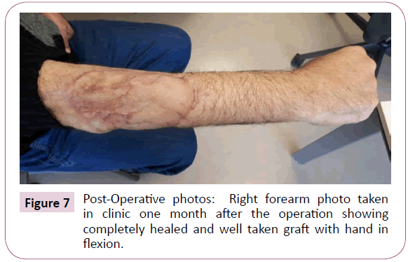 Cancer-Research-forearm-photo