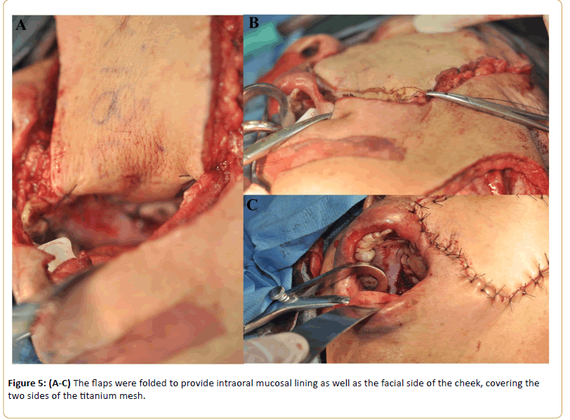 Cancer-Research-intraoral-mucosal-lining