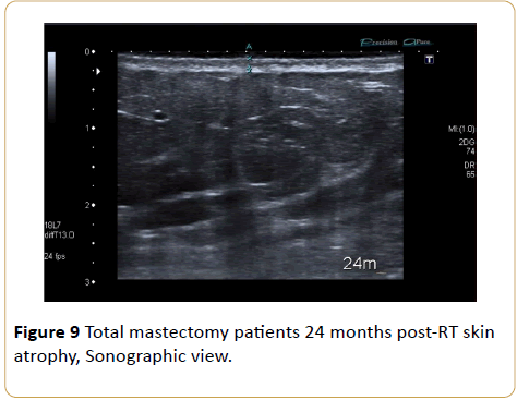 Cancer-Research-skin-atrophy-Sonographic