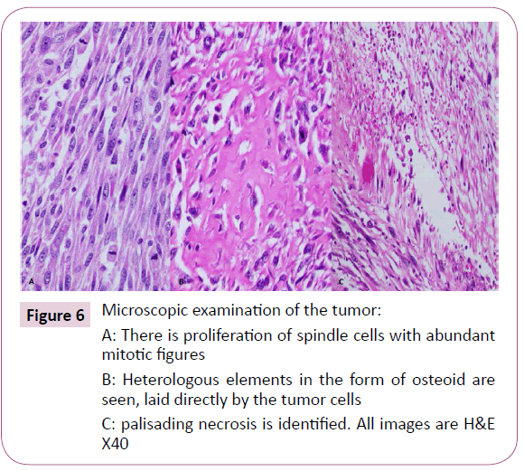 Massive Fungating Malignant Peripheral Nerve Sheath Tumor Arising