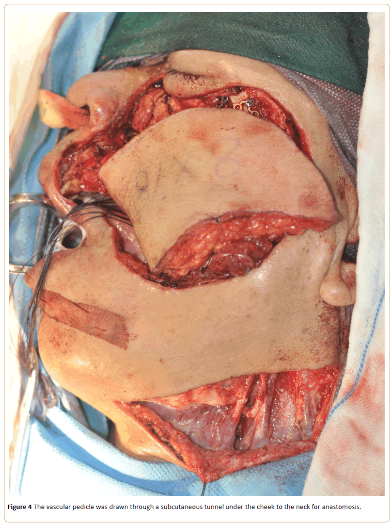 Cancer-Research-vascular-pedicle-anastomosis