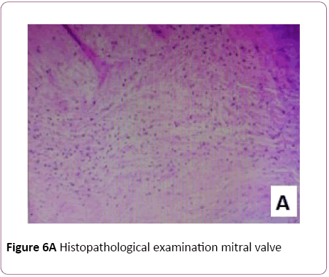 Clinical-Laboratory-Research-Histopathological-mitral