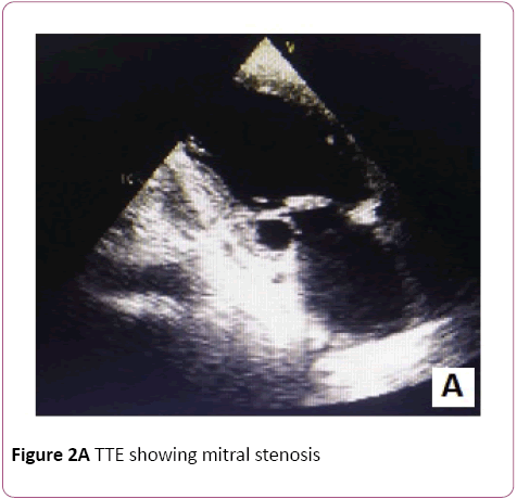 Clinical-Laboratory-Research-TTE-mitral-stenosis