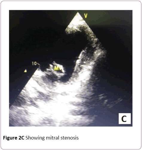 Clinical-Laboratory-Research-mitral-stenosis