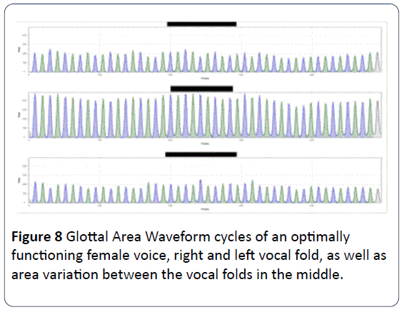 HSJ-Glottal-Area-optimally-functioning