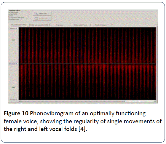 HSJ-Phonovibrogram-optimally-functioning