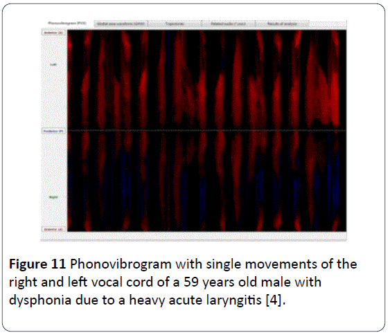 HSJ-Phonovibrogram-single-movements