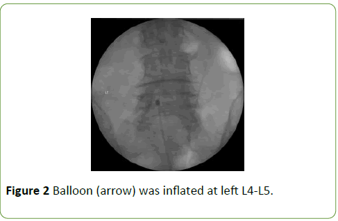 Neurology-Neuroscien-Balloon