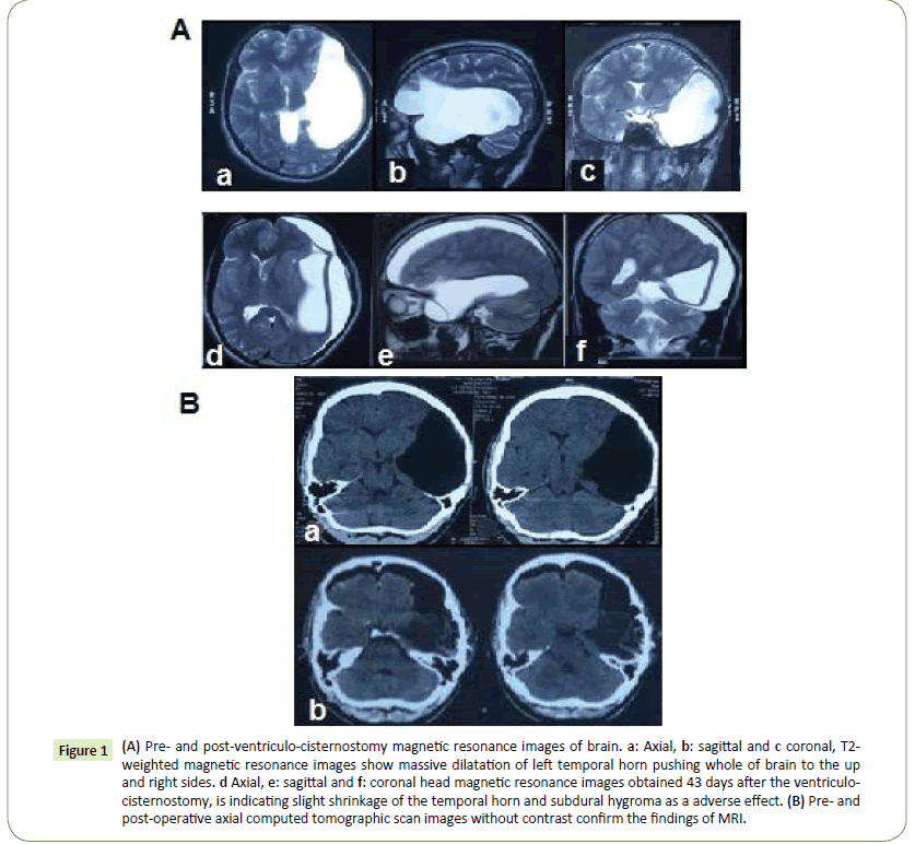 Neurology-Neuroscien-cecisternostomy