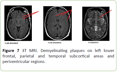 Neurology-Neuroscien-demyelinating