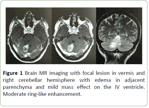 Neurology-Neuroscien-focal-lesion