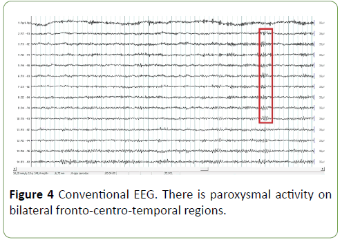 Neurology-Neuroscien-paroxysmal