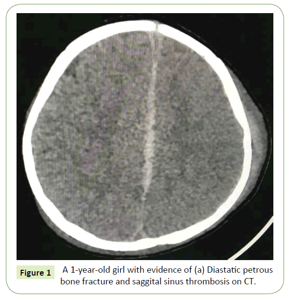 Neurology-Neuroscience-Diastatic-petrous